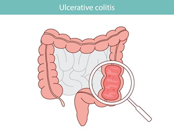 ulcerative colitis