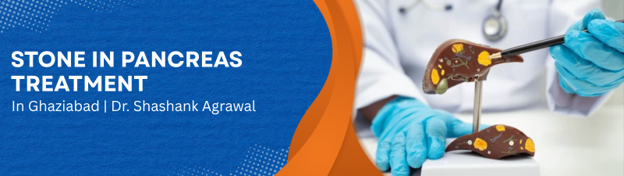 Banner advertising pancreatic stone treatment in Ghaziabad by Dr. Shashank Agrawal; left side has blue abstract design with text, right side shows gloved hands handling a pancreas model.