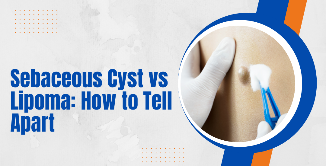 Sebaceous Cyst vs Lipoma: How to Tell Apart
