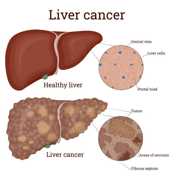 image1 - gisurgeryexpert.com/ Diagram showing a healthy liver and a liver with cancer, highlighting a tumor, areas of necrosis, and fibrous septa with labeled close-ups.