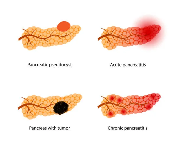 image1 - gisurgeryexpert.com/ Pancreas showing a pancreatic pseudocyst as a rounded orange mass on the organ with linked ducts nearby.