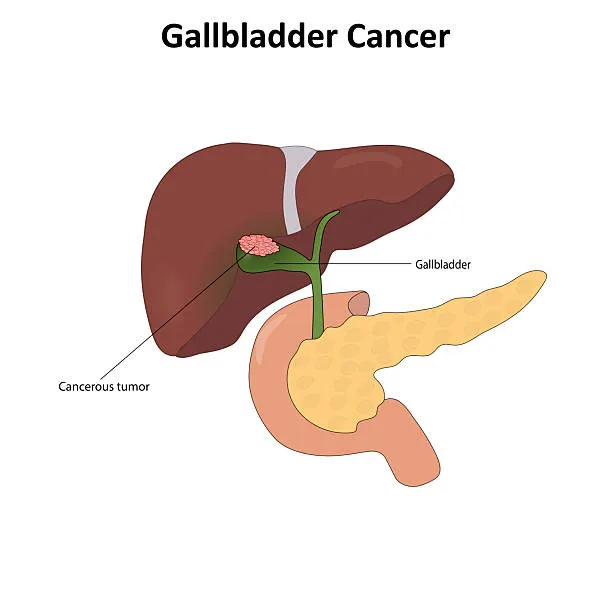 image10 - gisurgeryexpert.com/ Diagram showing liver, gallbladder, and pancreas with a cancerous tumor in the gallbladder.