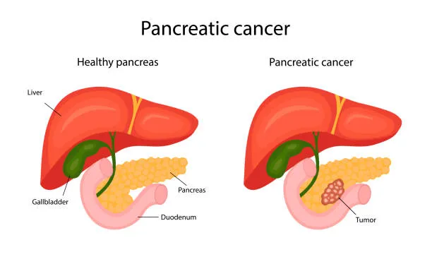 image12 - gisurgeryexpert.com/ Comparison diagram of a healthy pancreas and pancreatic cancer with labeled liver, gallbladder, pancreas, duodenum, and a tumor on the cancer image.