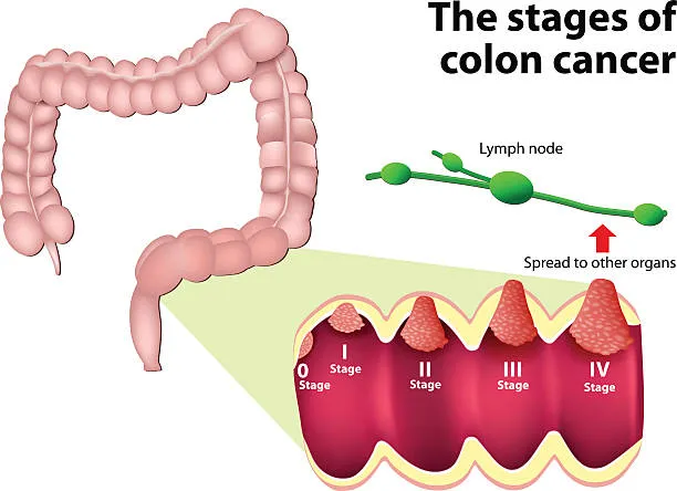 image14 - gisurgeryexpert.com/ Diagram of the colon showing cancer stages I–IV and a lymph node indicating spread to other organs.