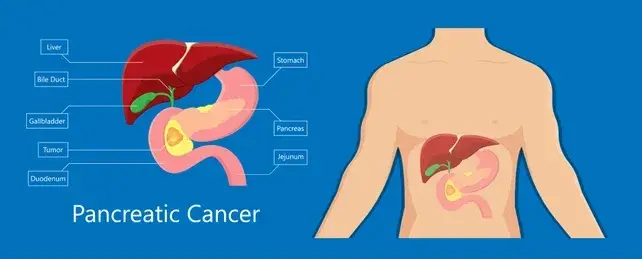 image15 - gisurgeryexpert.com/ Medical diagram of pancreatic cancer: labeled organs (liver, bile duct, gallbladder, stomach, pancreas, duodenum, jejunum) with the pancreas highlighted; torso illustration shows organ location.
