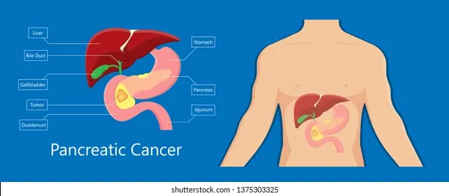 image15 - gisurgeryexpert.com/ Medical diagram of pancreatic cancer: labeled organs (liver, bile duct, gallbladder, stomach, pancreas, duodenum, jejunum) with the pancreas highlighted; torso illustration shows organ location.