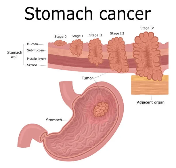 image16 - gisurgeryexpert.com/ Educational diagram of stomach cancer showing tumor in the stomach and cancer stages 0 through IV along the stomach wall.