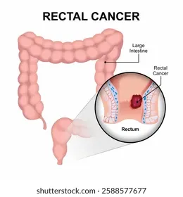 image2 - gisurgeryexpert.com/ Diagram of the large intestine showing rectal cancer with a magnified inset of a tumor in the rectum.