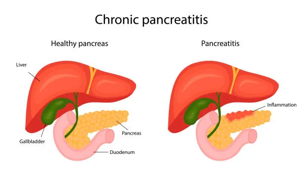 image6 - gisurgeryexpert.com/ Comparison of healthy pancreas vs pancreatitis, showing inflammation in the right pancreas and labeled liver, gallbladder, and duodenum.
