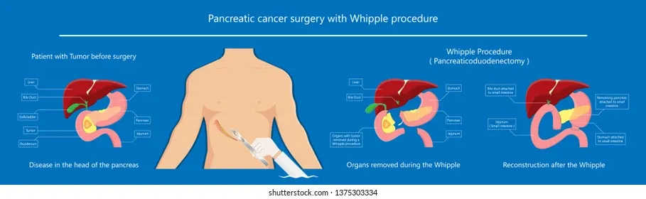 image8 1 - gisurgeryexpert.com/ Infographic: Pancreatic cancer surgery with Whipple procedure—left shows a tumor in the head of the pancreas, middle shows organs removed, right shows reconstruction after surgery.