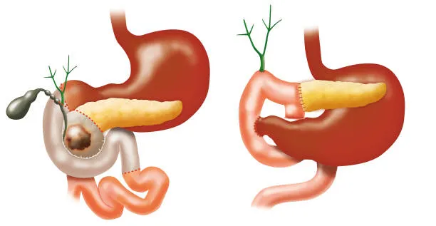 image9 1 - gisurgeryexpert.com/ Diagram of Roux-en-Y gastric bypass showing a divided stomach forming a small pouch and rerouted small intestine with a Y-shaped limb